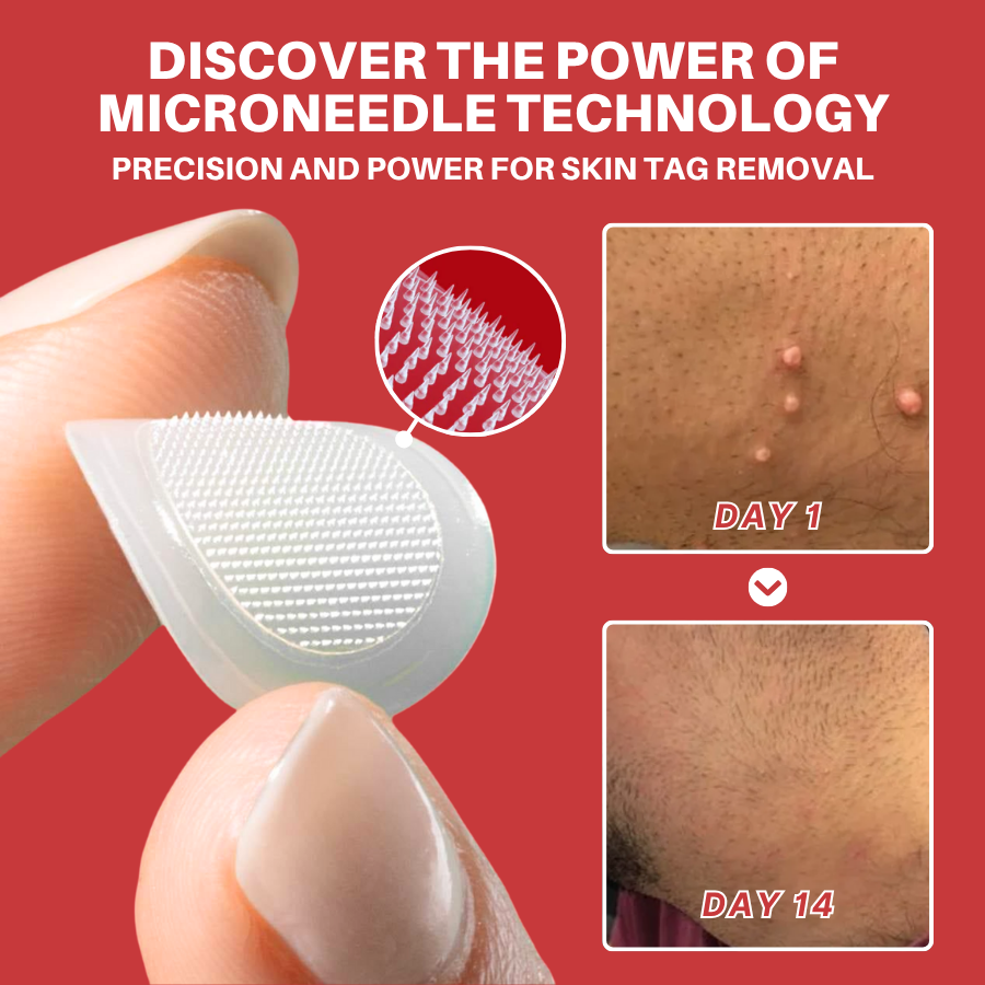 Fivfivgo® MicroNeedle Botanic Skin Tag Removal Patch