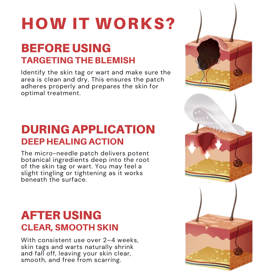 Fivfivgo® MicroNeedle Botanic Skin Tag Removal Patch
