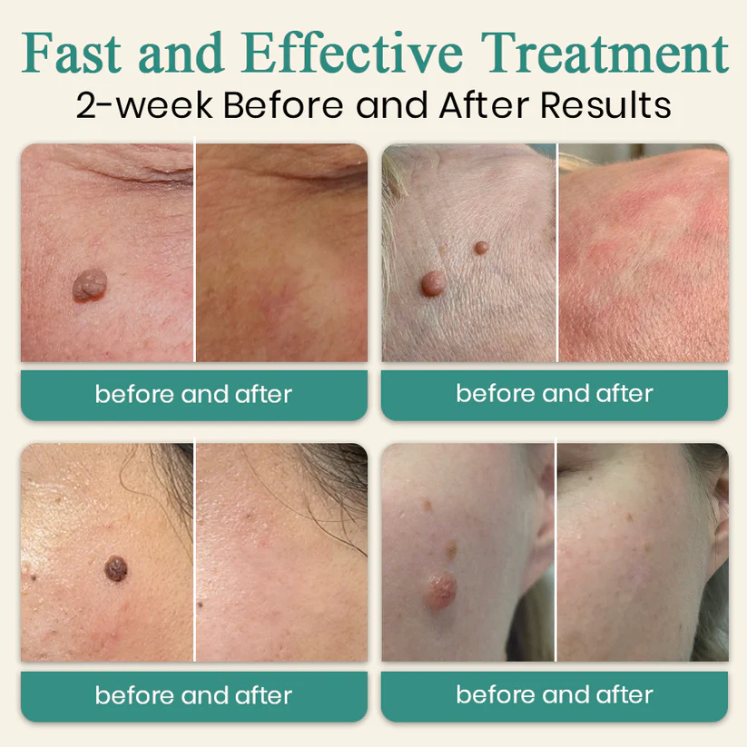 Bikenda® Mole and Wart Instant Removal Laser Pen