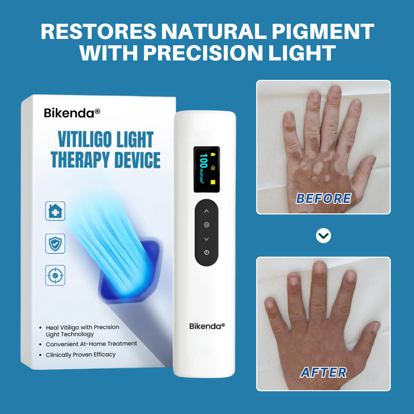 Bikenda® Vitiligo Light Therapy Device
