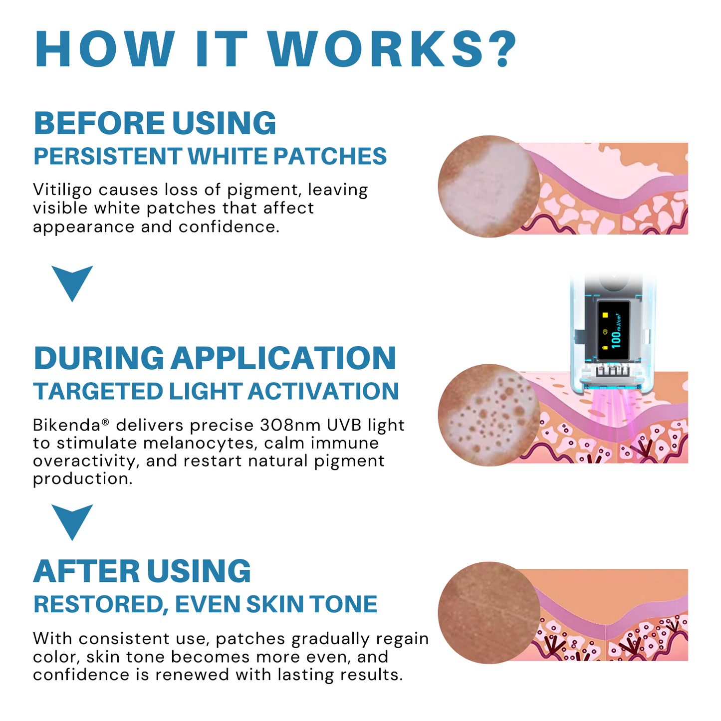 Bikenda® Vitiligo Light Therapy Device