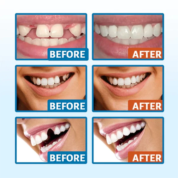 Fivfivgo® Glory Smile Temporary Tooth Sculptor Repair Kit