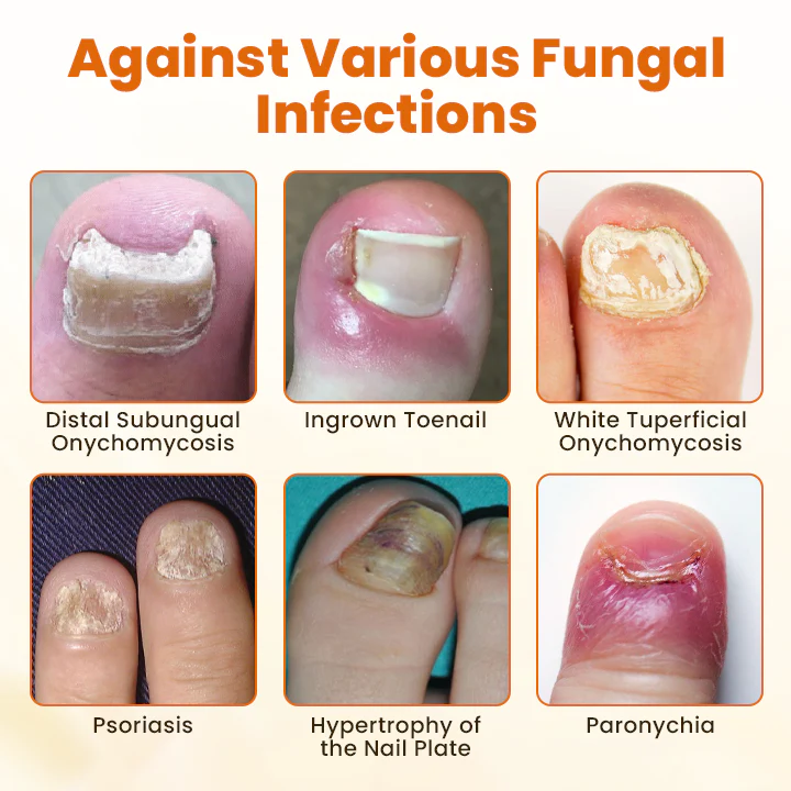 Fivfivgo® FungiBee Advanced Nail Repair Spray