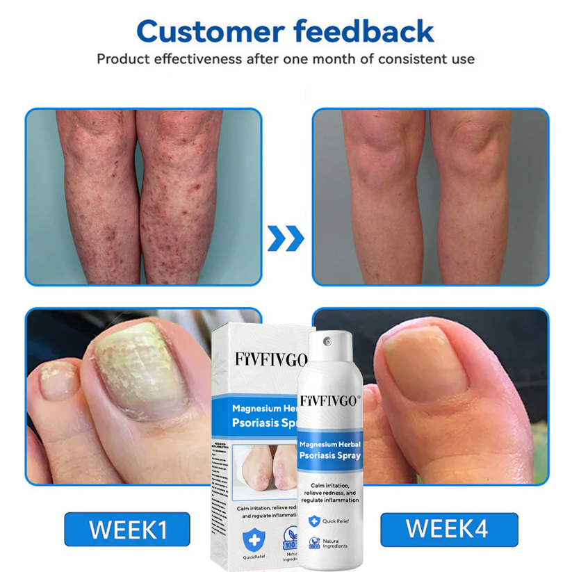 Fivfivgo® Magnesium Herbal Psoriasis Spray image Fivfivgo® Magnesium Herbal Psoriasis Spray
