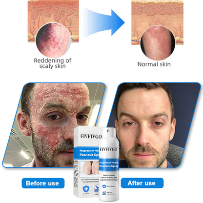 Fivfivgo® Magnesium Herbal Psoriasis Spray
