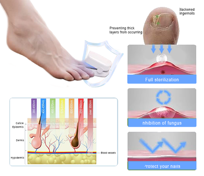 Fivfivgo™ Revolutionary High-Efficiency Light Therapy Device For Toenail Diseases