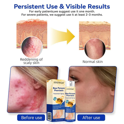 Fivfivgo® Bee Poison Psoriasis Treatment Spray