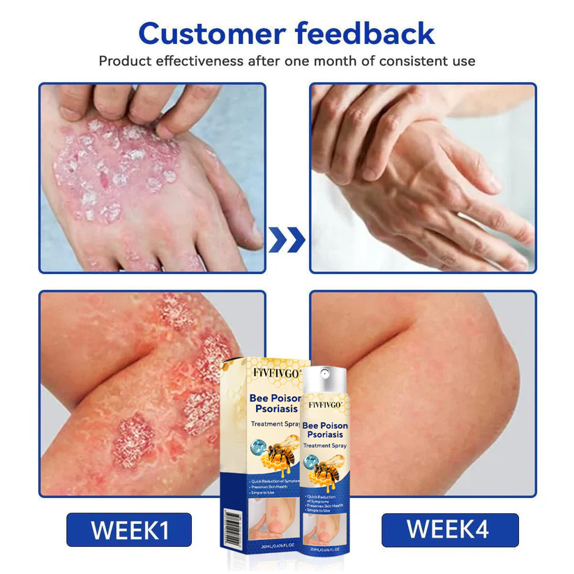 Fivfivgo® Bee Poison Psoriasis Treatment Spray