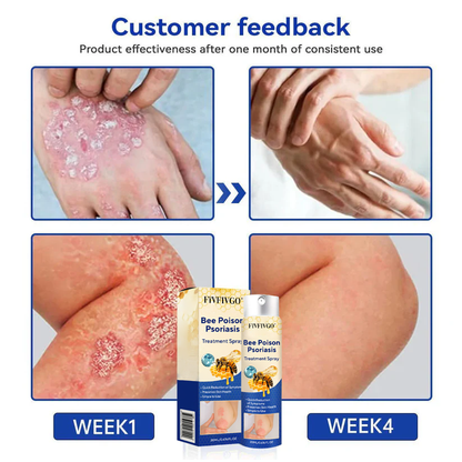 Fivfivgo® Bee Poison Psoriasis Treatment Spray