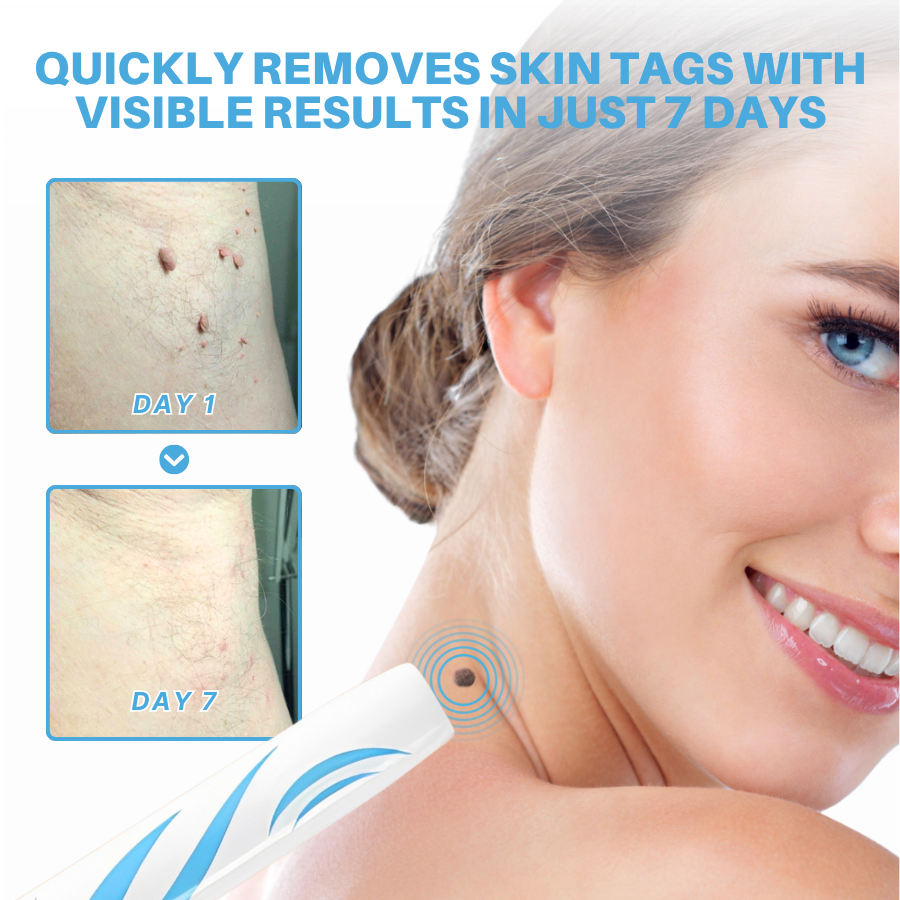 Bikenda® Painless At-home Skin Tag Removal Pen