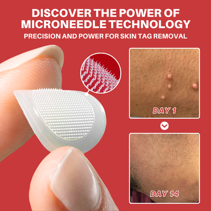 Fivfivgo® MicroNeedle Botanic Skin Tag Removal Patch