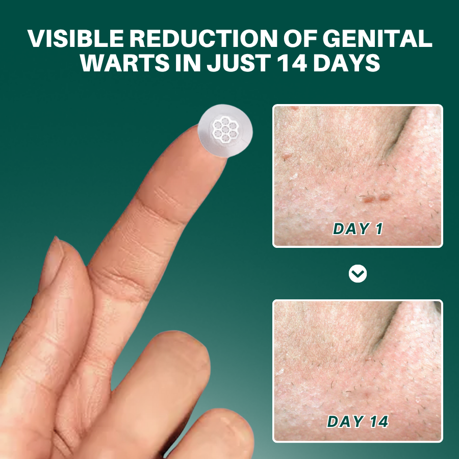 Fivfivgo® Magnesium MicroPin HPV Genital Wart Removal Patch