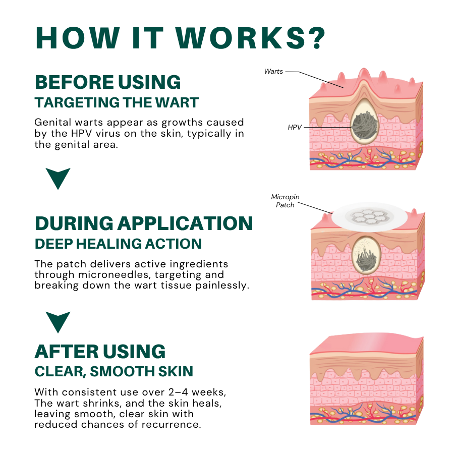 Fivfivgo® Magnesium MicroPin HPV Genital Wart Removal Patch
