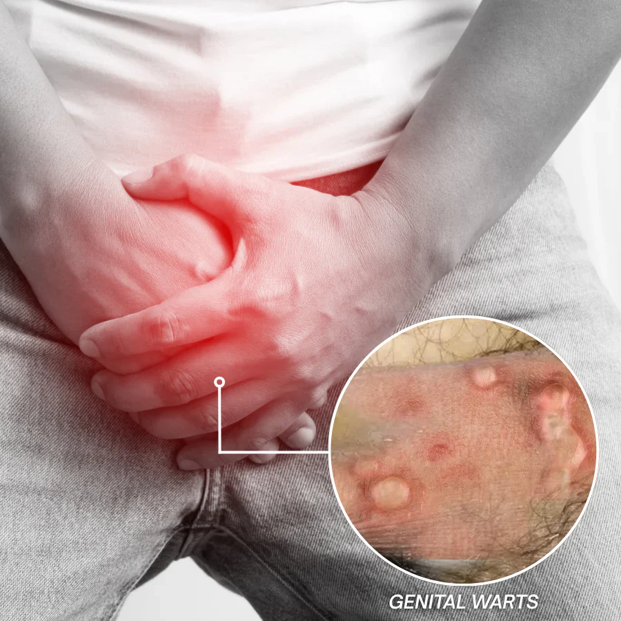 Fivfivgo® Magnesium MicroPin HPV Genital Wart Removal Patch