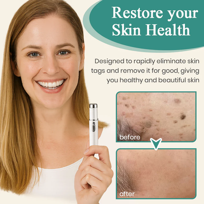 Bikenda® Mole and Wart Instant Removal Laser Pen