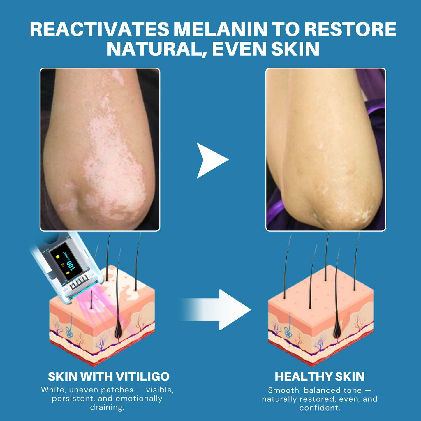 Bikenda® Vitiligo Light Therapy Device