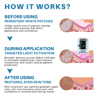 Bikenda® Vitiligo Light Therapy Device