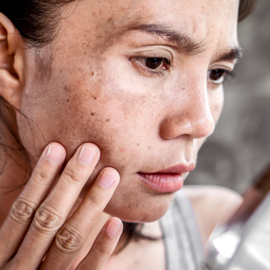 Fivfivgo® Botanical Freckles & Spot Removal Patch 17 Fivfivgo® Botanical Freckles & Spot Removal Patch