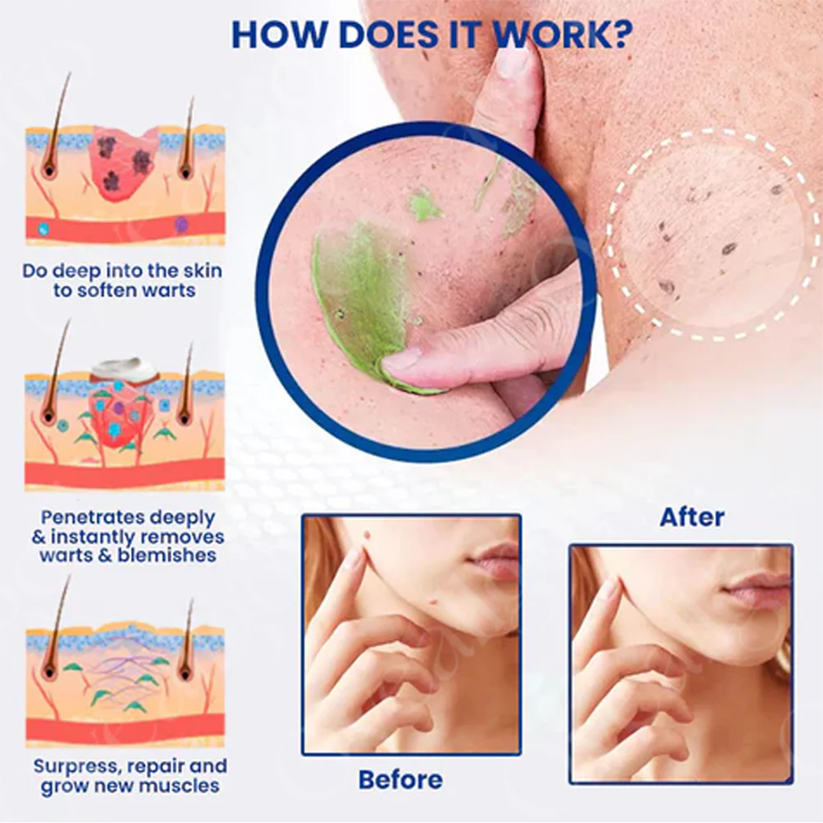 Fivfivgo® NatureErase Instant Mole & Spot Removal Gel PRO image Fivfivgo® NatureErase Instant Mole & Spot Removal Gel PRO