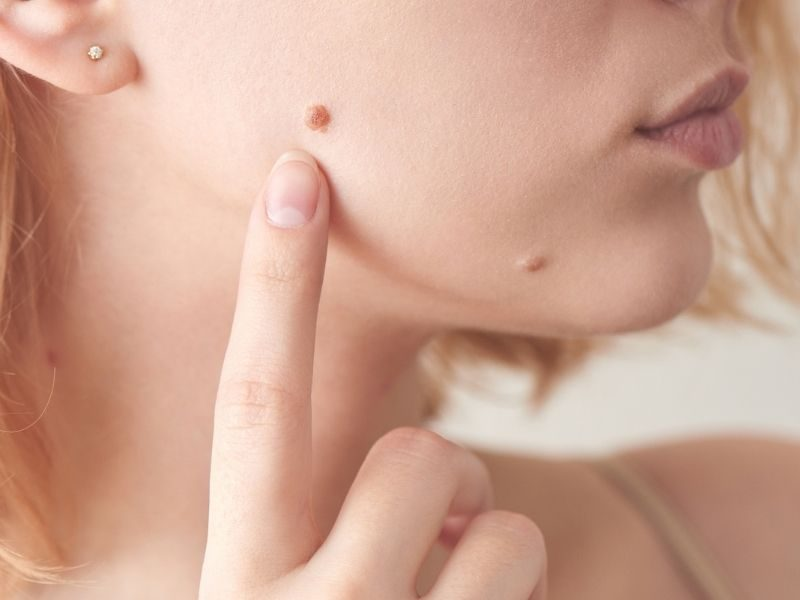 Fivfivgo® NatureErase Instant Mole & Spot Removal Gel PRO image Fivfivgo® NatureErase Instant Mole & Spot Removal Gel PRO