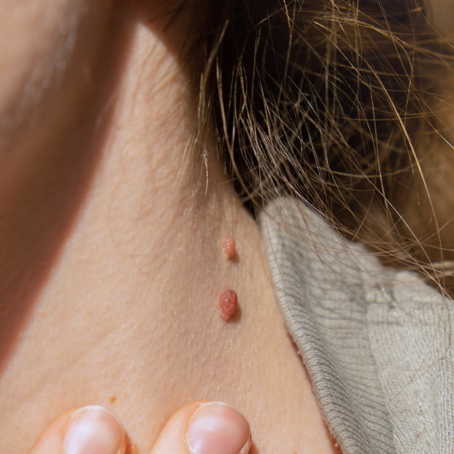 Fivfivgo® Moles & Warts Removing Skin Tag Patch image Fivfivgo® Moles & Warts Removing Skin Tag Patch