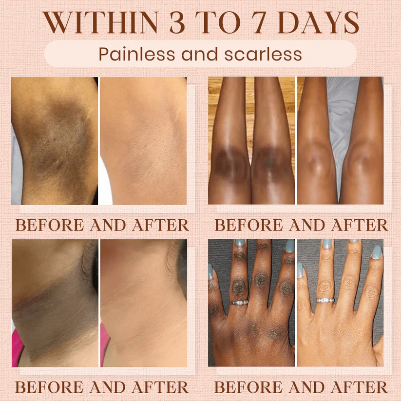 Fivfivgo® Purifying Exfoliating Gel for Acanthosis Nigricans, Exfoliation, Dark Spots, Skin Tags, and Eczema
