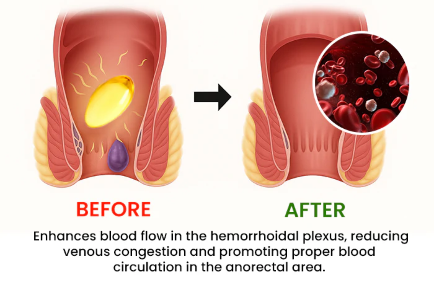 Fivfivgo® Natural Hemorrhoid Capsules image Fivfivgo® Natural Hemorrhoid Capsules