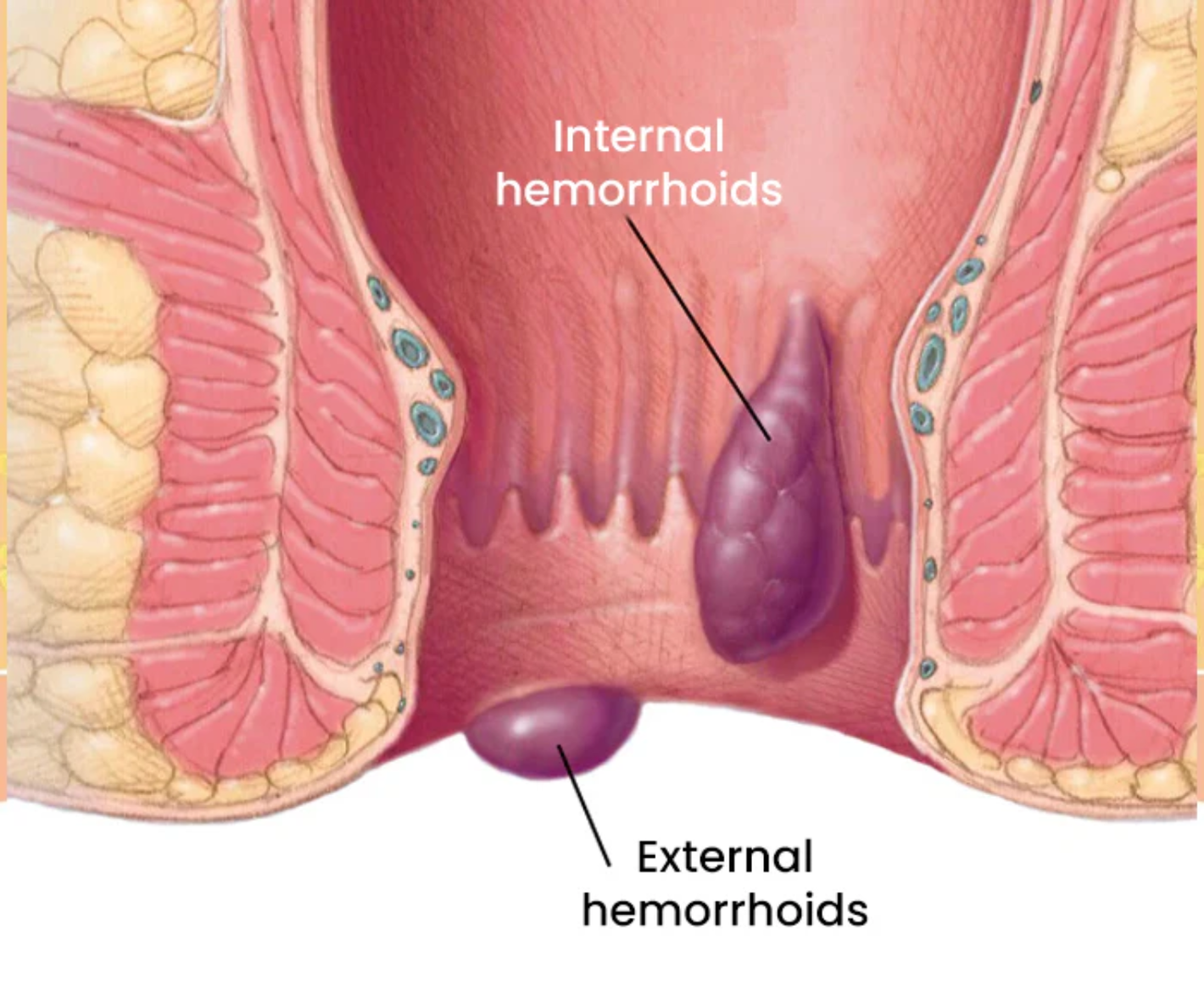 Capsules naturelles pour hémorroïdes