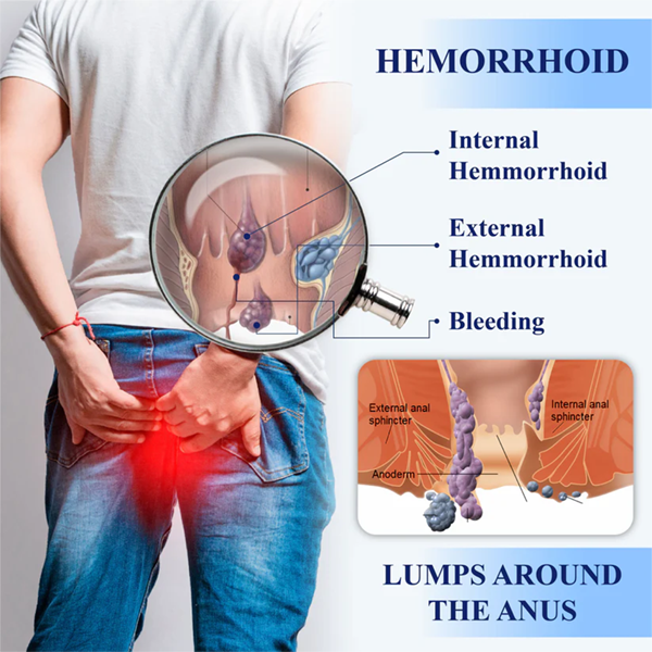 Fivfivgo® Hemorrhoid Treatment Gel