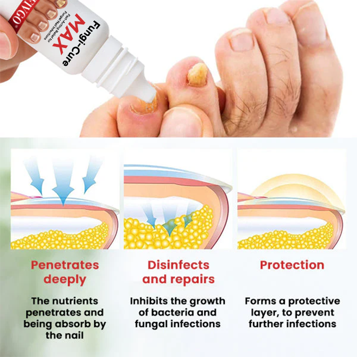 Fivfivgo® Fungi-Cure Max – Fast-Acting Relief for Fungal Nail Infections