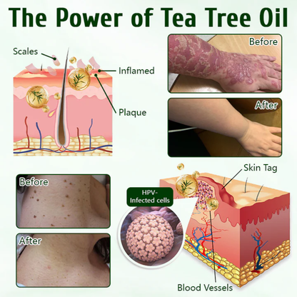 Fivfivgo® DermaPure Tea Tree Healing Cream
