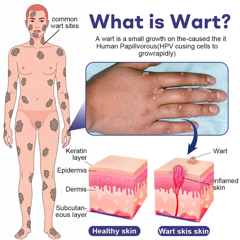 Fivfivgo® Wart Eraser Pro