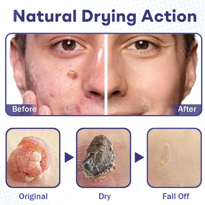 Fivfivgo® Wart Eraser Pro