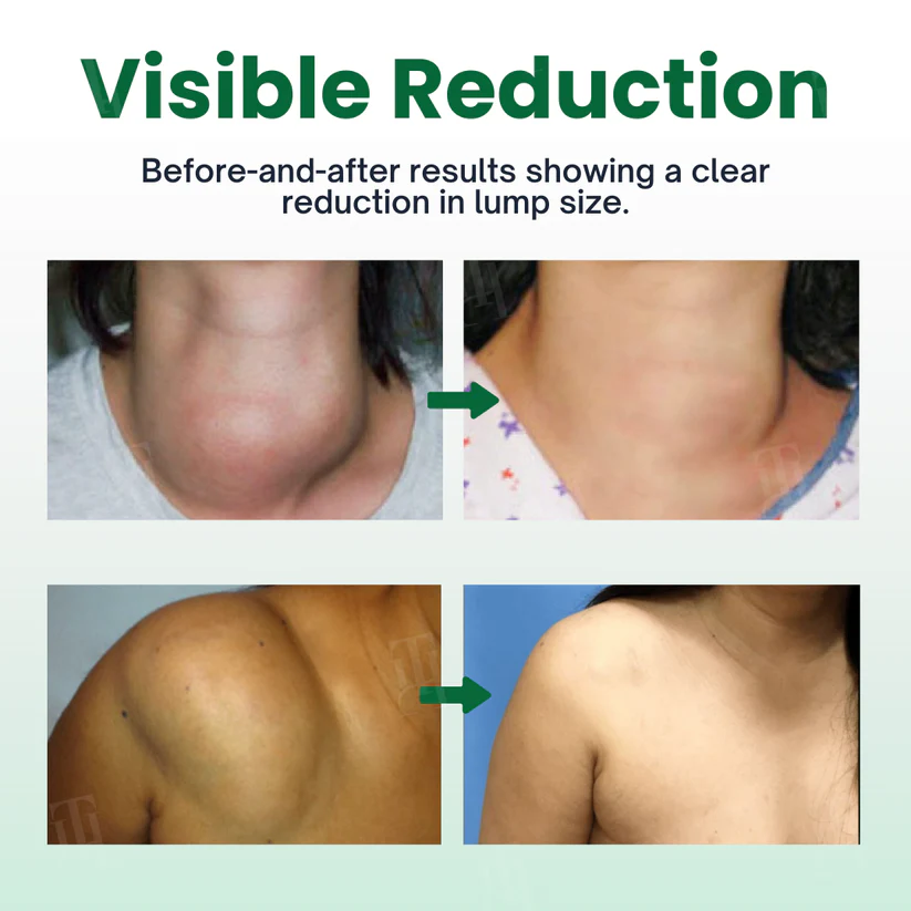 Cvreoz® Knot-X Lipoma Dissolve Cream