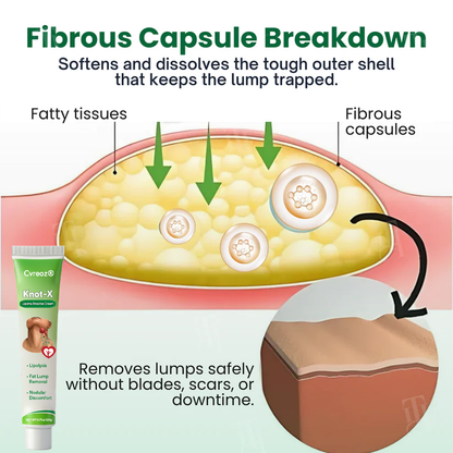 Cvreoz® Knot-X Lipoma Dissolve Cream