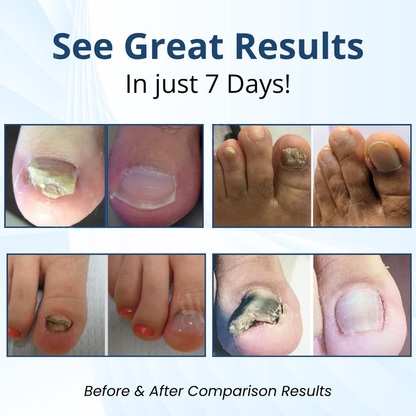 Fivfivgo® MycoShield Pro Fungal Nail Patches 🏥 Visible Results In 2 Days + Professional Grade Repair