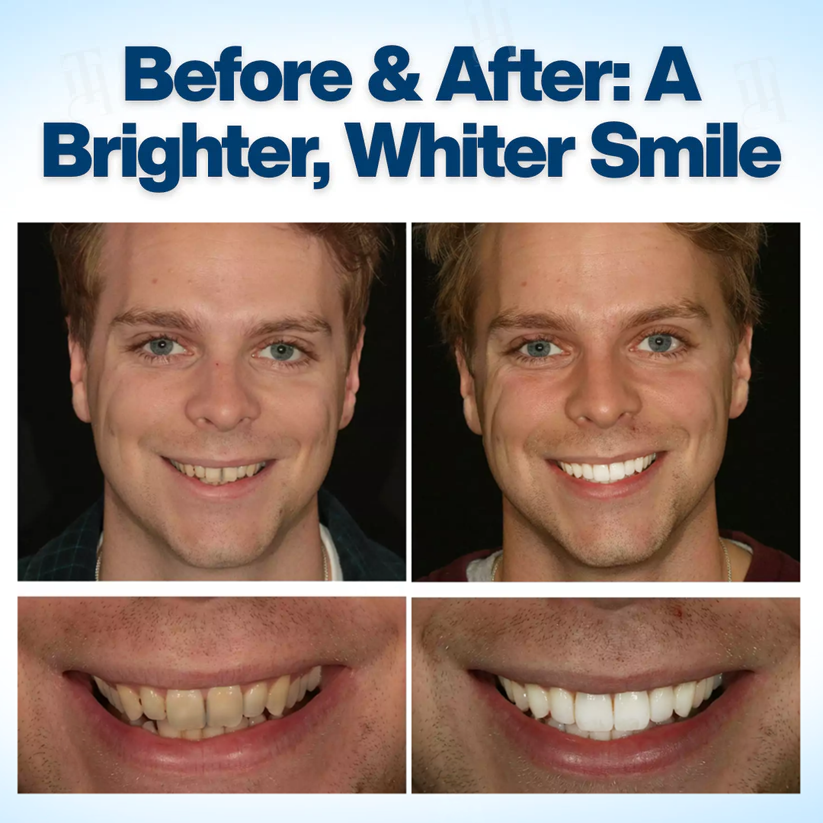 Fivfivgo® WhitenEase Pro Whitening Pen