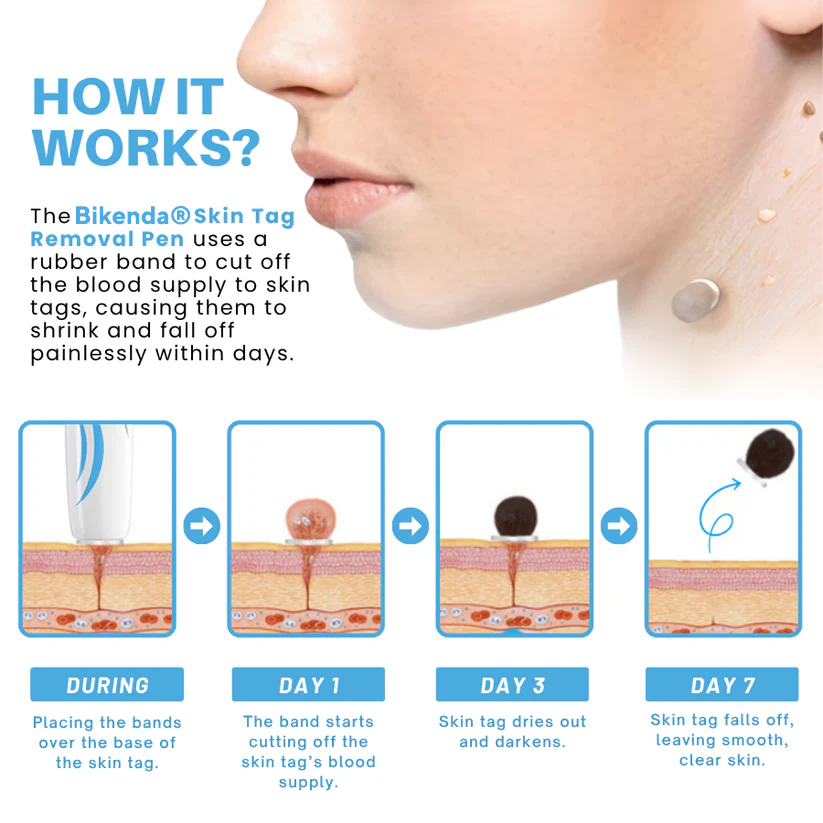 Bikenda® Painless At-home Skin Tag Removal Pen