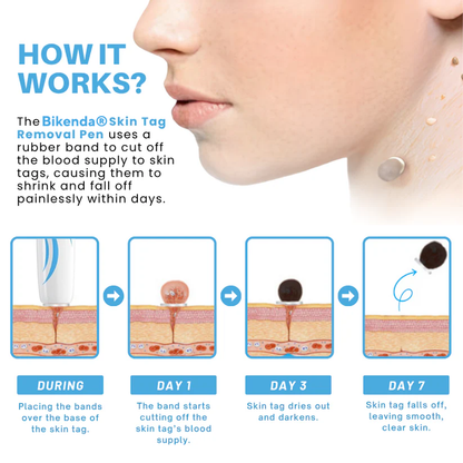Bikenda® Painless At-home Skin Tag Removal Pen