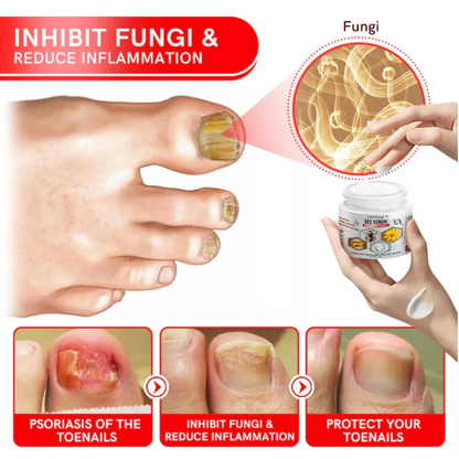 Fivfivgo™ Bee Venom Multi-Symptom Psoriasis Cream