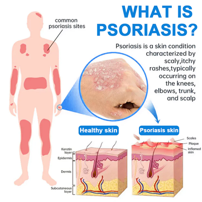 Fivfivgo® Magnesium Herbal Psoriasis Spray