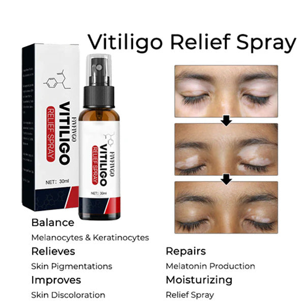 Fivfivgo™ Vitiligo Relief Spray