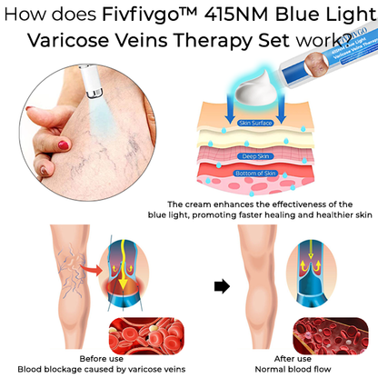 Fivfivgo™ 415NM Blue Light Varicose Veins Therapy Set