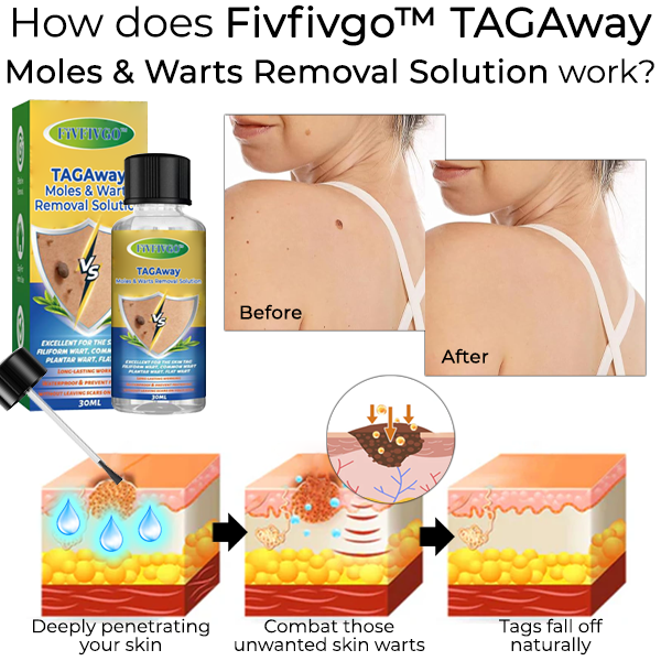 Fivfivgo™ TAGAway Moles & Warts Removal Solution