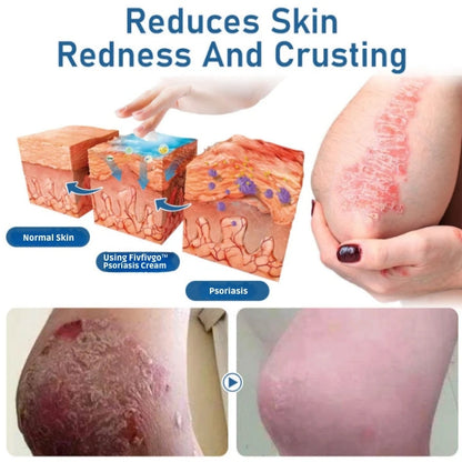 Fivfivgo™ Psoriasis Moisturizing and Soothing Cream