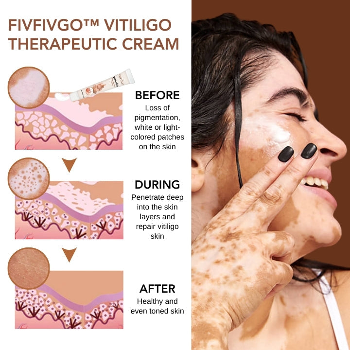 Fivfivgo™ Vitiligo Therapeutic Cream