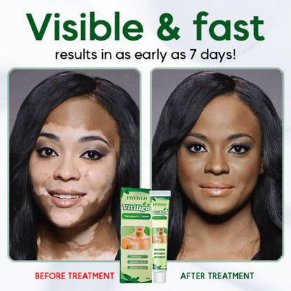 Fivfivgo™ Vitiligo Therapeutic Cream 🔥 Expert-Approved! Get Your Special Offers While They Last! 💸