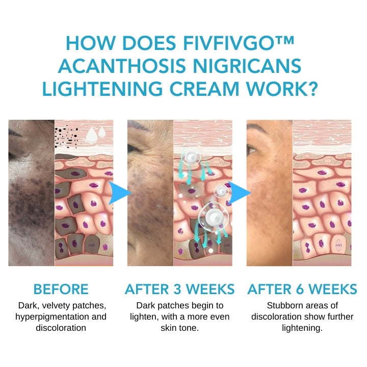 Fivfivgo™ Acanthosis Nigricans Lightening Cream