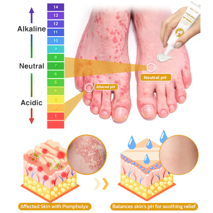 Fivfivgo™ Pompholyx Relief Cream