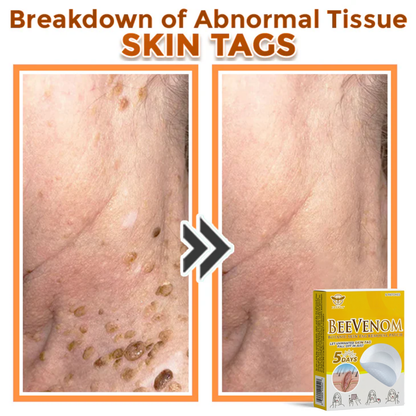 Fivfivgo® Bee Venom Botanic Skin Tag Removal Patch 🇺🇸 Made in the USA